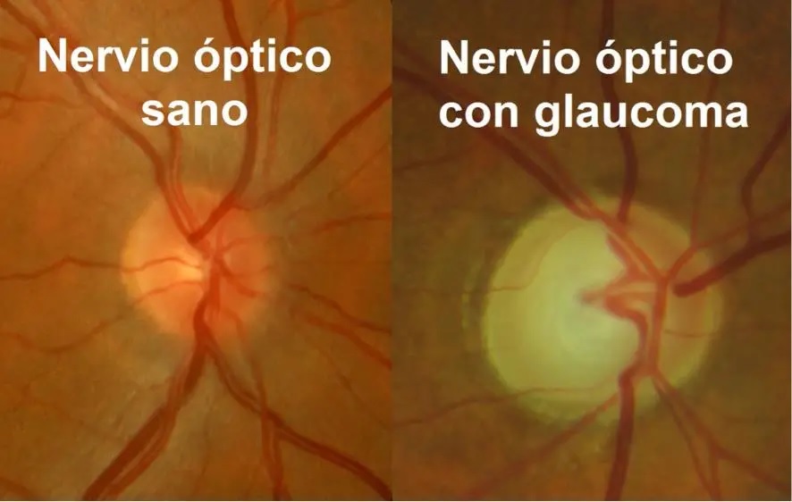 oct nervio optico